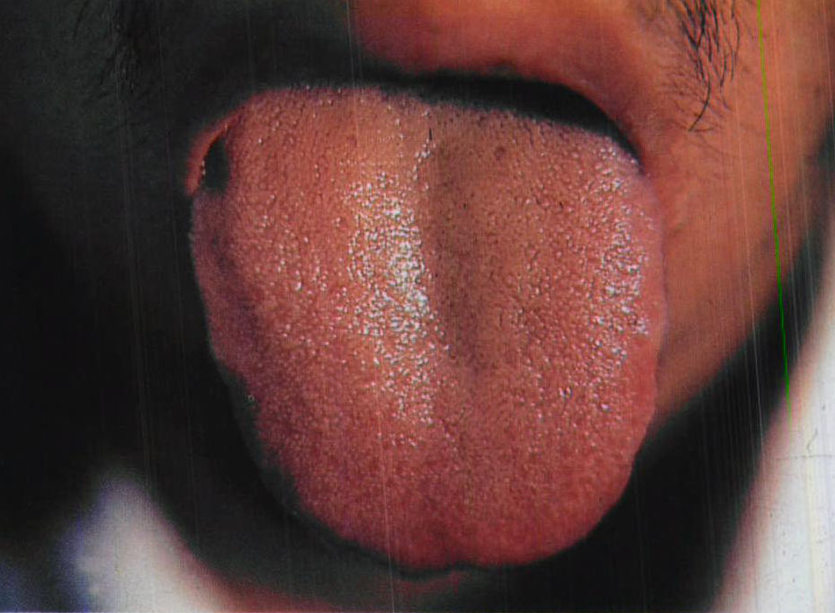 膽氣犯胃